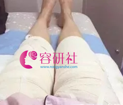 韩国dreamline吸脂塑形医院大腿吸脂术后前期