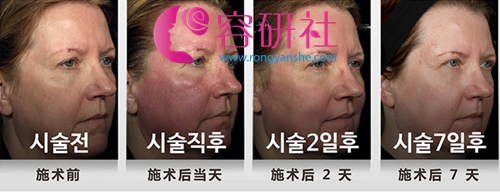 韩国Tam皮肤科双飞梭镭射术前术后对比