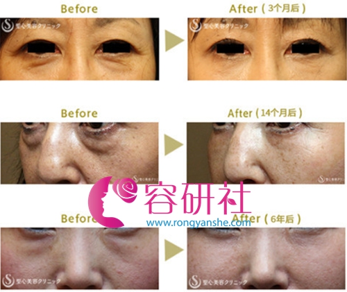 日本圣心医疗美容医院PRP皮肤美容再生疗法真实案例