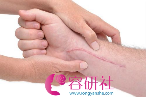 韩国gio医院疤痕修复：只要愈合不要留疤