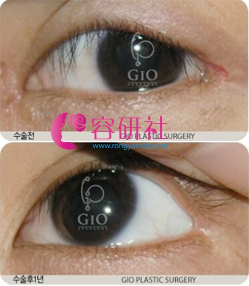 韩国gio整形医院眼角疤痕修复实例