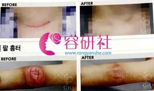 韩国gio整形医院高难度疤痕修复实例
