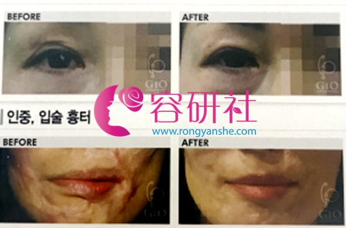 韩国gio整形医院面部疤痕修复案例