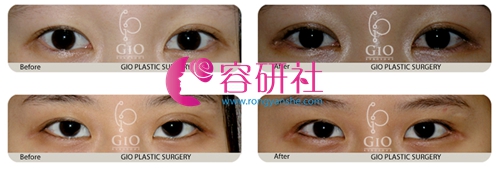 韩国gio整形医院双眼皮不对称修复实例