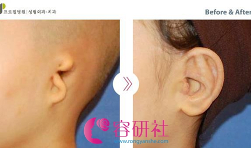 韩国普露菲耳profile整形医院小耳症改善案例
