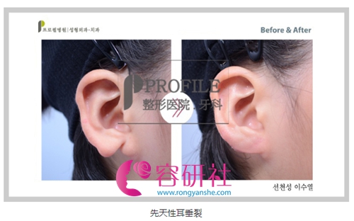 韩国普露菲耳profile 整形医院耳缺失改善手术案例