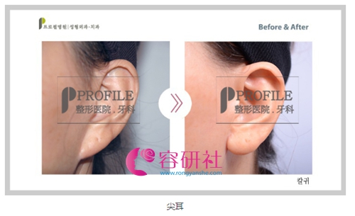 韩国普露菲耳profile 整形医院耳垂改善案例
