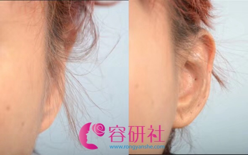 韩国普露菲耳profile整形医院贴发耳改善案例