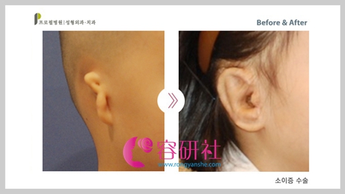 韩国普露菲耳profile整形医院耳再造手术案例