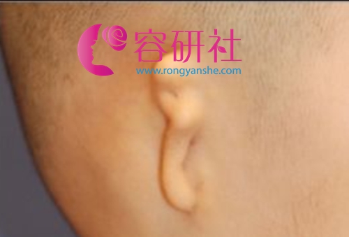  韩国普露菲耳（profile）整形外科医院小耳症现象