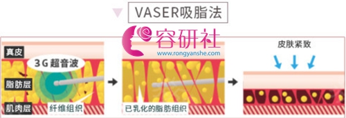日本Mods Clinic VASER吸脂法