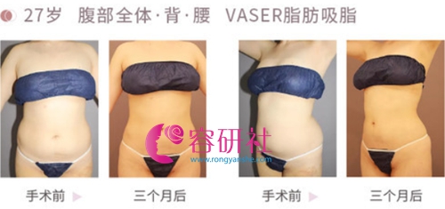 日本Mods Clinic VASER吸脂腹部全体案例对比图