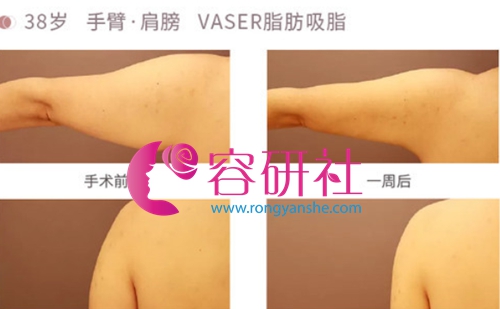 日本Mods Clinic VASER吸脂手臂案例对比图