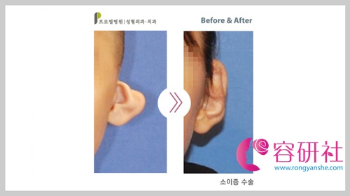 韩国profile整形外科郑在皓院长耳畸形矫正手术