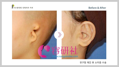 韩国profile整形外科耳畸形耳再造手术案例