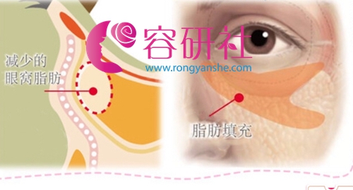 日本银座美幸美容外科祛黑眼圈眼袋方法