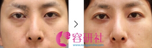 日本银座美幸美容外科祛黑眼圈眼袋日记对比图