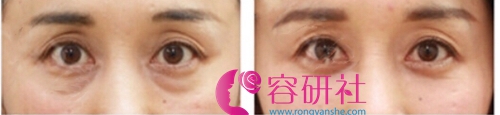 日本银座美幸美容外科祛黑眼圈眼袋日记对比图