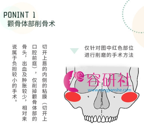 日本自由之丘美容整形医院颧骨颧弓术手术过程