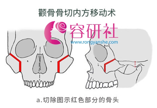日本自由之丘美容整形医院颧骨颧弓术手术过程