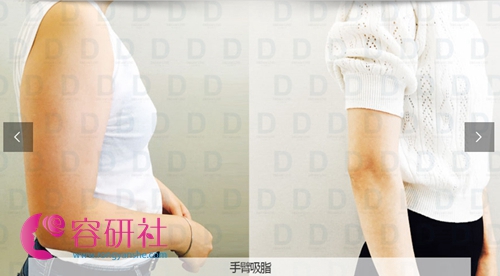 韩国dreamline吸脂塑形医院手臂吸脂日记对比图