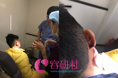 韩国普露菲耳profile整形医院耳再造案例术后前期效果