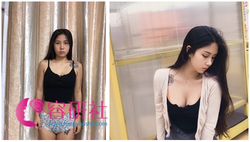 韩国普露菲耳（profile）整形医院魔笛假体隆胸案例对比图