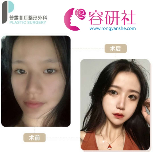 韩国profile普露菲耳下颌角手术日记