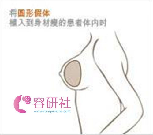 韩国普露菲耳proflie整形医院做假体隆胸圆形植入胸部效果图