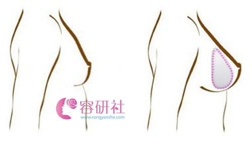 韩国普露菲耳proflie整形医院做假体隆胸水滴型植入效果图