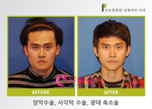 韩国普露菲耳profile整形医院面部轮廓手术日记