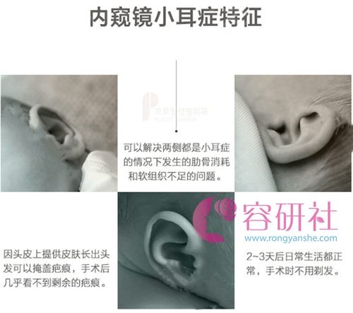 韩国普露菲耳proflie整形医院内窥镜小耳症特征
