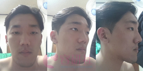 韩国普露菲耳profile整形医院面部轮廓手术前