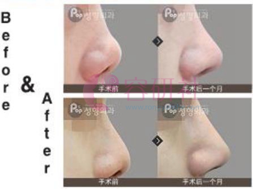 韩国pop整形医院鼻综合手术案例