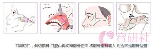 韩国普罗菲耳proflie整形医院颧骨颧弓整形术切口方式