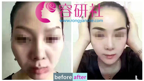 韩国普罗菲耳profile整形医院自体脂肪填充全脸真人案例