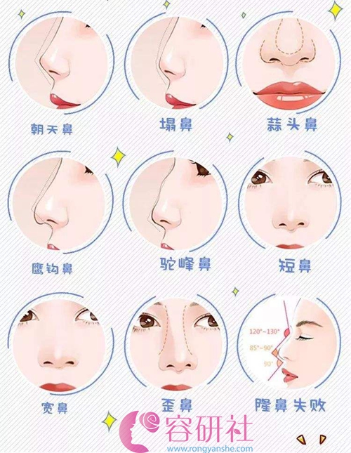 韩国普罗菲耳profile医院鼻子种类 