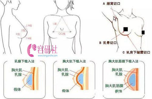 隆胸手术教程图片