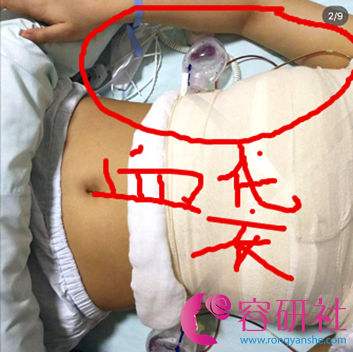 韩国普罗菲耳整形医院隆胸对比日记