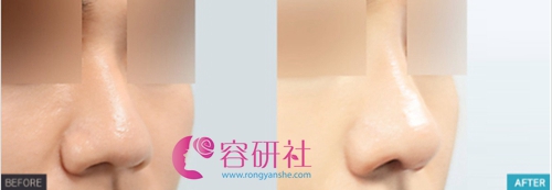 韩国普罗菲耳profile整形医院鼻综合案例对比图