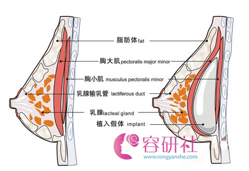 韩国profile普罗菲耳整形医院郑在皓院长假体隆胸双平面植入技术