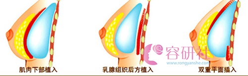 韩国profile普罗菲耳整形医院郑在皓院长假体隆胸双平面技术优势