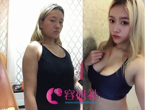 韩国profile普罗菲耳整形医院假体隆胸手术案例
