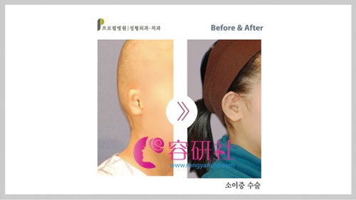 韩国普罗菲耳profile整形医院外耳廓畸形矫正日记