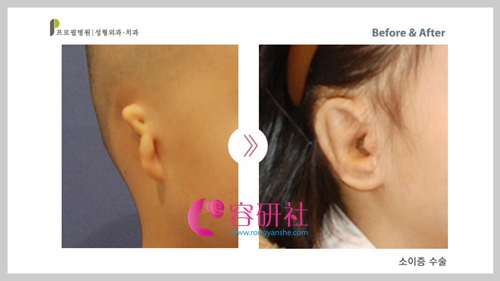 韩国普罗菲耳profile整形医院外耳廓畸形矫正案例