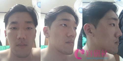 韩国profile普罗菲耳整形医院面部轮廓术前