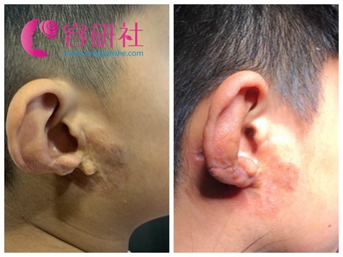 韩国普罗菲耳profile医院小耳畸形矫正日记