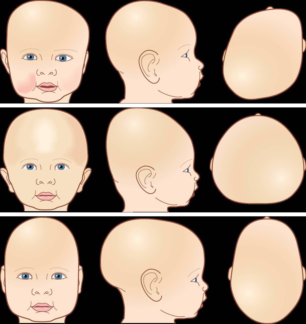 婴儿头颅异常的几种情况分析
