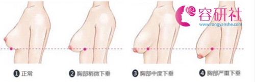 韩国profile普罗菲耳医院乳房下垂类型