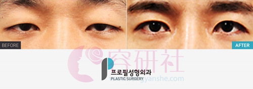 韩国profile普罗菲耳整形医院眼综合手术案例